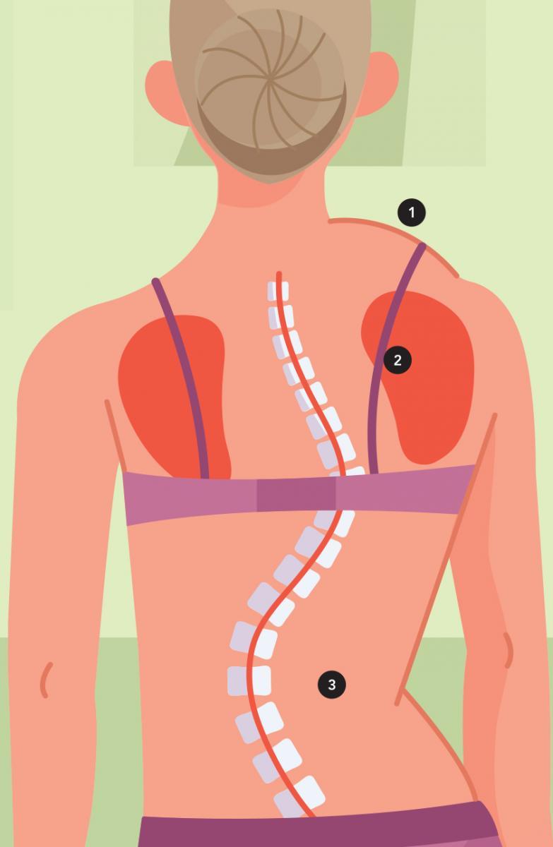 signes de la scoliose en position debout