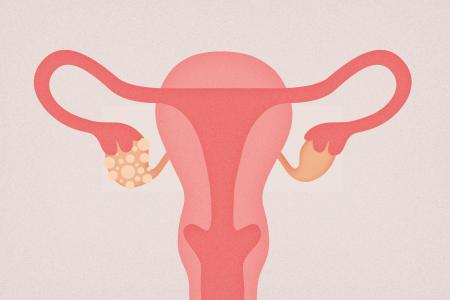 Le syndrome des ovaires polykystiques, un mal encore sous-estimé