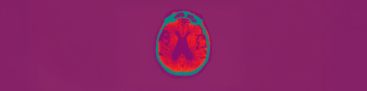 Alzheimer: un nouveau médicament enfin disponible