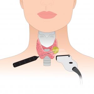 illustration : radiofréquence pour détruire les nodules thyroïdiens