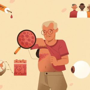 illustration : Le zona