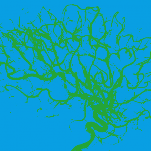 Migraine : des maux à tue-tête