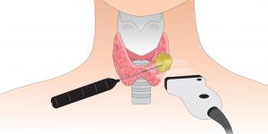illustration : radiofréquence pour détruire les nodules thyroïdiens