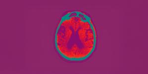 Alzheimer: un nouveau médicament enfin disponible